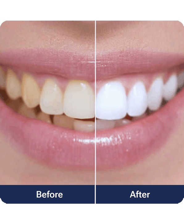 LED Teeth Whitening System